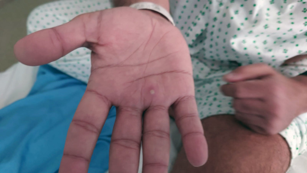 The monkeypox virus can be spread through direct exposure to lesions.