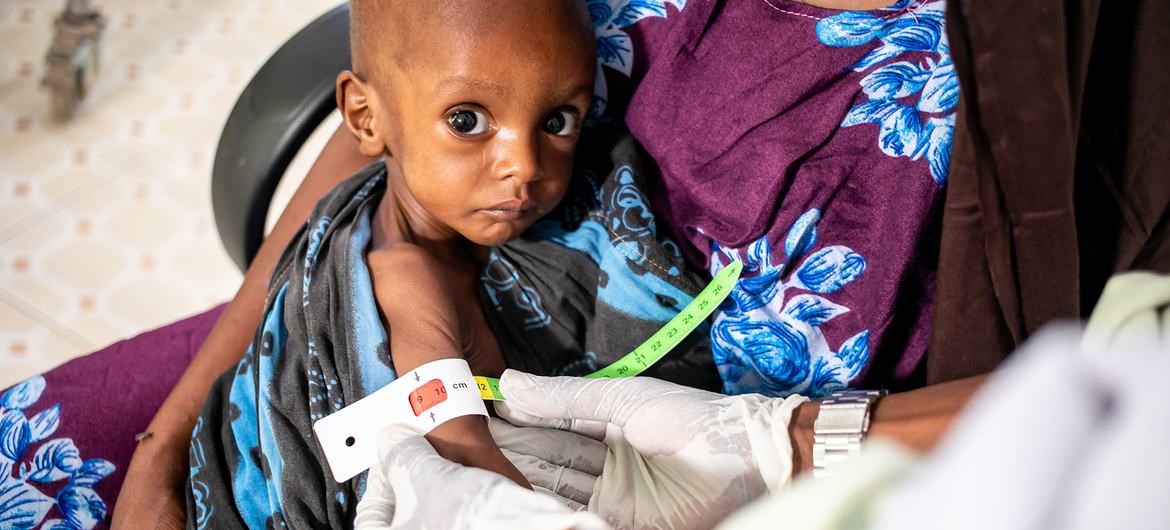 This severely malnourished one-year-old is receiving care at a hospital in Dolow, Ethiopia.