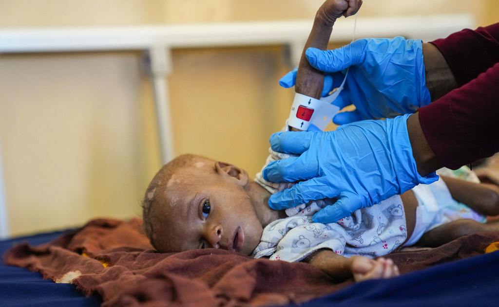 A doctor measures the arm circumference of Ibrahim, an eight-month-old boy suffering from malnutrition, at a hospital in Mogadishu, Somalia.