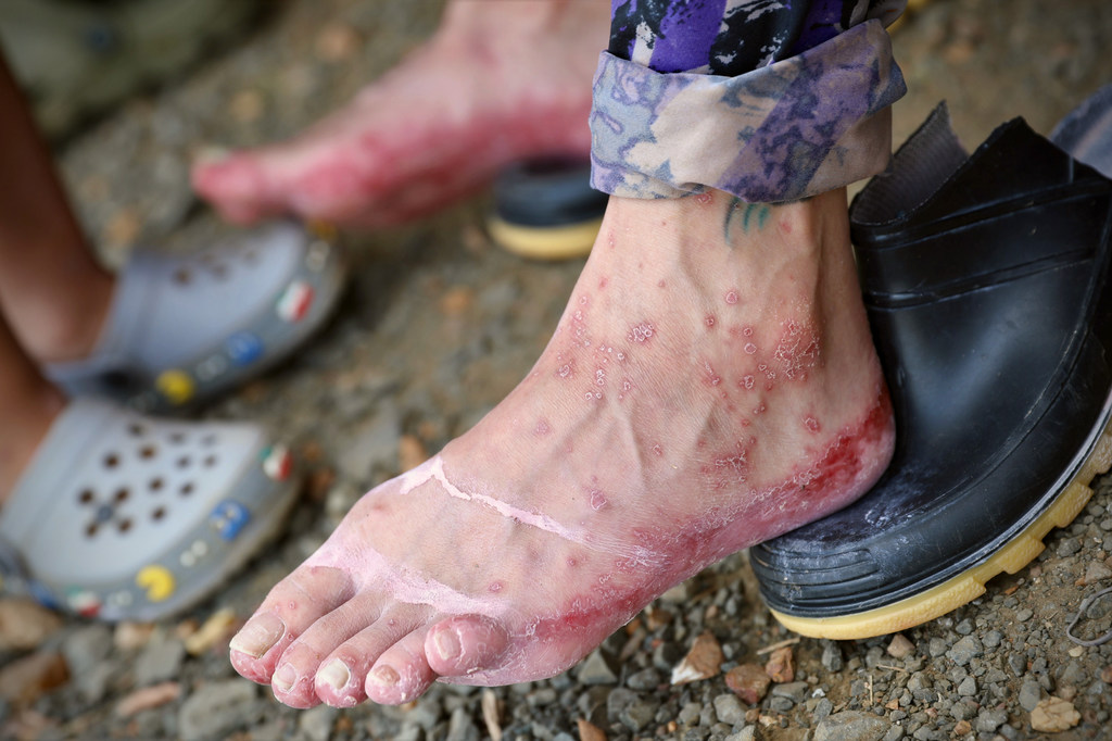 A migrant arrived in Lajas Blancas, Panama, with his feet covered in blood.