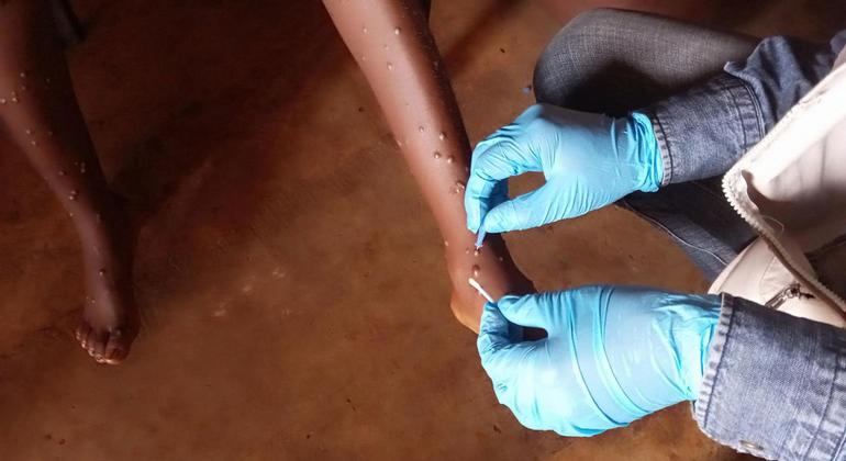 Scaling up response to curb growing MPOX outbreak in African region.